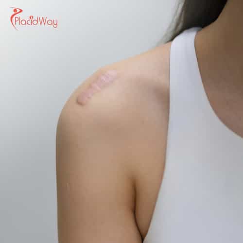 Shoulder Replacement Surgery in Turkey: Affordable Solutions for Australians with Joint Pain